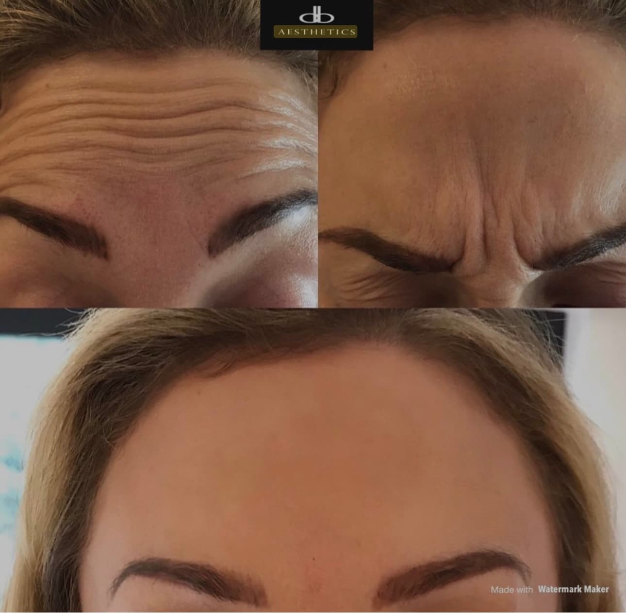 Botulinum Toxin