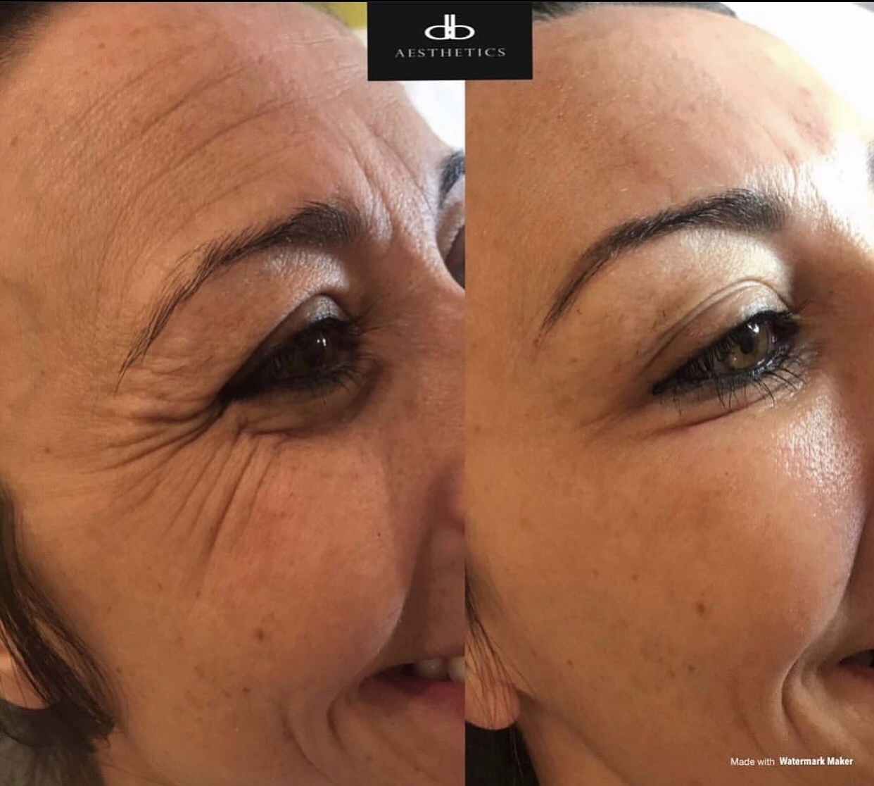 Botox