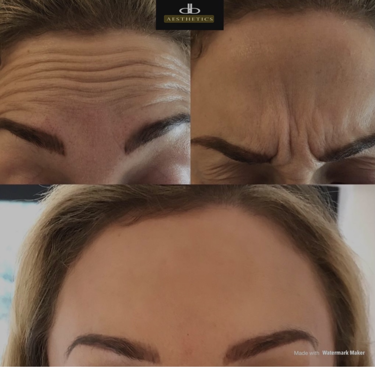 Botulinum Toxin