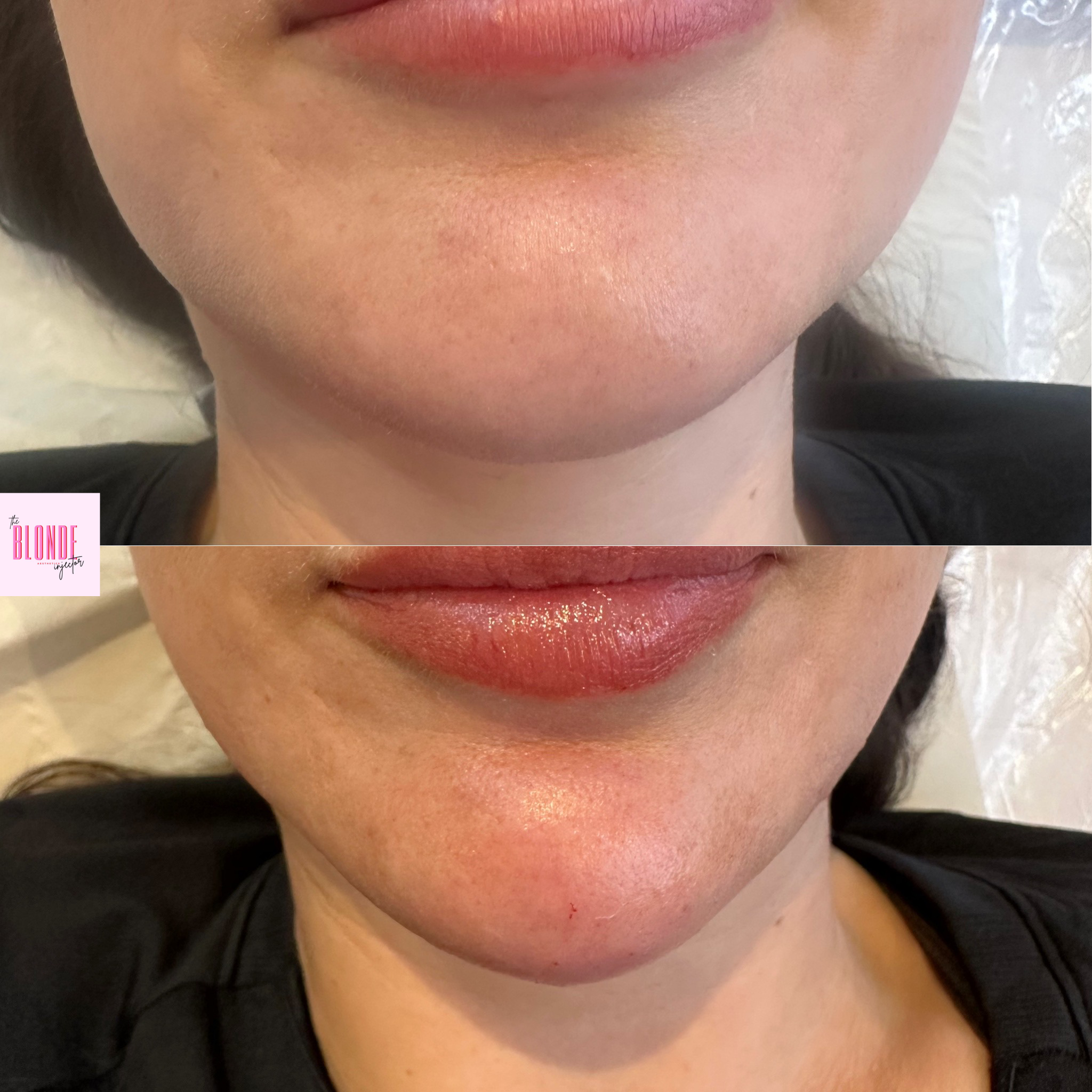 Chin Re-shape